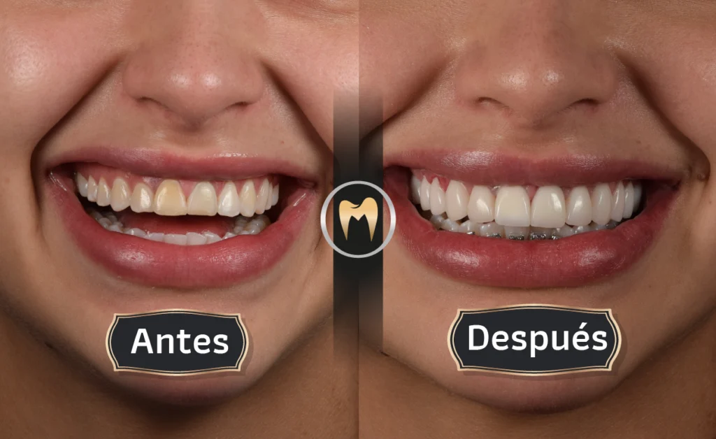 IMAGEN CASO DE ÉXITO ANTES-DESPUÉS ORAL MASTER ODONTOLOGÍA ESTÉTICA Y LABORATORIO DENTAL