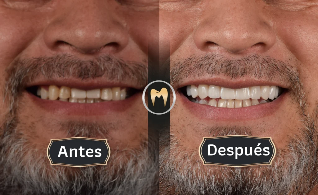 IMAGEN CASO DE ÉXITO ANTES-DESPUÉS ORAL MASTER ODONTOLOGÍA ESTÉTICA Y LABORATORIO DENTAL