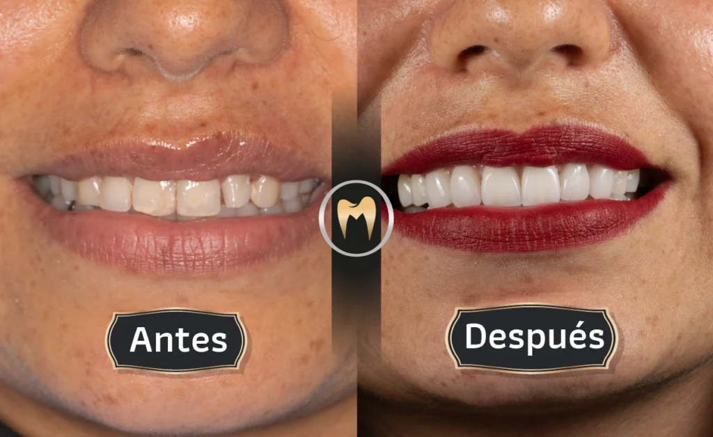 IMAGEN CASO DE ÉXITO ANTES-DESPUÉS ORAL MASTER ODONTOLOGÍA ESTÉTICA Y LABORATORIO DENTAL